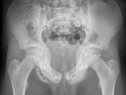 apophysiolysis of the spina iliaca anterior inferior. Avulsionsverletzungen Der Huftregion Des Jugendlichen Springerlink