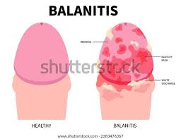 Image result for penis mycosis symptoms