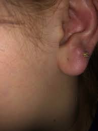 I Ve Had My Seconds Pierced For Over Three Years And My Other Ear Has Healed Completely Fine But This Ear Has Had Scar Tissue For About A Yr Should I Remove The