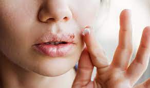 How To Get Rid Of Pimple Scabs | Proactiv®