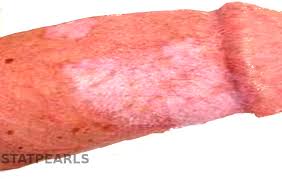 Check spelling or type a new query. Figure Lichen Sclerosus Contributed By Dermnetnz Statpearls Ncbi Bookshelf
