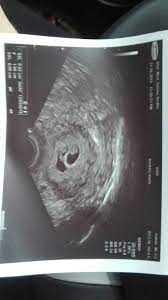 Dottersack Ohne Embryo 6 3 Schwanger Wer Noch