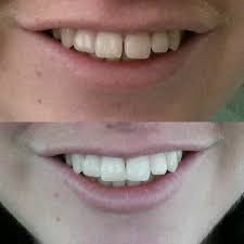This resin can be mixed in various shades to get the closest match possible, especially for front teeth. 12 Dental Bonding Ideas Dental Dental Bonding Dental Care