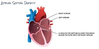 Image result for Atrial Septal Defect