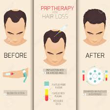 Hair cycle and hair pigmentation: Platelet Rich Plasma Injection Prp Therapy Process Female Hair Royalty Free Cliparts Vectors And Stock Illustration Image 59304836