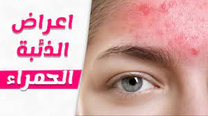 ويصيب الالتهاب الناتج عن هذا المرض العديد من أعضاء الجسم، مثل. Ø¹Ù„Ø§Ø¬ Ø§Ù„Ø°Ø¦Ø¨Ø© Ø§Ù„Ø­Ù…Ø±Ø§Ø¡ Ø¨Ø§Ù„Ø§Ø¹Ø´Ø§Ø¨ Ø¹Ù„Ø§Ø¬ Ø§Ù„Ø°Ø¦Ø¨Ø© Ø§Ù„Ø­Ù…Ø±Ø§Ø¡ Ø¨Ø§Ù„Ø¹Ø³Ù„