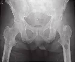 Normally a large variety of plasma cells produce various forms of immunoglobulin, however, in myeloma one particular plasma cell clone begins to replicate in an uncontrolled manner. X Ray Of The Pelvis Showing Multiple Osteolytic Lesions In The Left Download Scientific Diagram