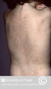 Image result for Hypertrichosis