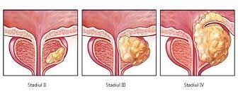 La ce medic sa te prezinti, ce examinari sunt posibile, ce probleme de fertilitate pot exista. Cancer La Prostata Cauze Simptome Diagnostic Tratament