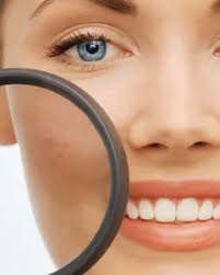 Image result for xantelasma