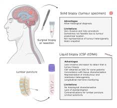 The removed tissue is examined for cancer or any other cell abnormalities. Cancers Free Full Text Ctdna Based Liquid Biopsy Of Cerebrospinal Fluid In Brain Cancer