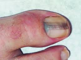 Melanomas can vary greatly in how they look. Subungual Melanoma Of The Big Toe In A 62 Year Old Man The Color Is Download Scientific Diagram
