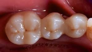 The phosphate ion in the acid greatly reduces any potential bonding to the zirconia. Zirconia Treatment For Efficient Cementation Process Dentistry33
