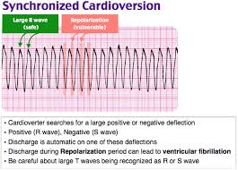 Image result for Synchronized Cardioversion