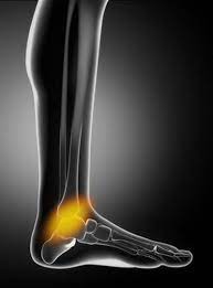 La plus probable, la plus fréquente et la plus bénigne étant la périostite tibiale. Douleurs De La Cheville Symptomes Traitement Definition Docteurclic Com