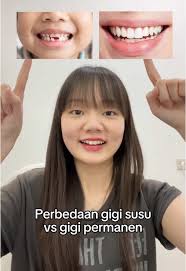 Perbedaan Gigi Susu dan Gigi Permanen untuk Anak