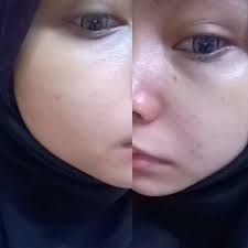 Game insight has released a new game in the genre where it excels most: The Life Of Mansor S Twins My First Laser Treatment At Myclinic