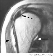 Image result for Shoulder History