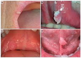 Image result for papillomavirus tongue)