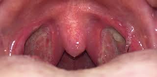 HOW RISKY IS A TONSILLECTOMY? - The anesthesia consultant