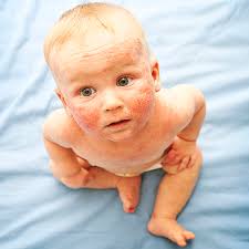 The latest news on pregnancy, baby's first years, and parenting resources. Neurodermitis Katja Weidemann Heilpraktikerin Fur Kinder