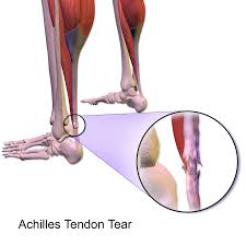 Maybe you would like to learn more about one of these? What S The Difference Between A Ligament Sprain And A Muscle Strain My Sacroiliac Joint Saga