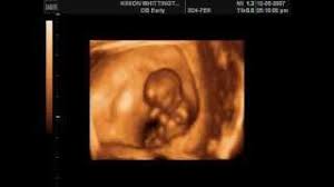 Ecografia 4d De Un Bebe De 11 Semanas