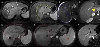 References In Budd Chiari Syndrome And Hepatic Regenerative Nodules Magnetic Resonance Findings With Emphasis Of Hepatobiliary Phase European Journal Of Radiology