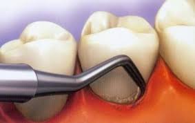 Image result for ‫بروساژ دندان‬‎