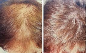 Hair loss treatments for women are available in a few different formulas. Hair Loss Treatment Testimonials Before After Photos In Chester
