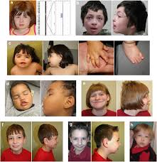 İlerleyen günlerde aygün aydınhakkında bilgiler güncellenecektir. Disruption Of Mbd5 Contributes To A Spectrum Of Psychopathology And Neurodevelopmental Abnormalities Molecular Psychiatry