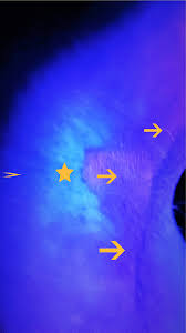 Image result for Erythrasma