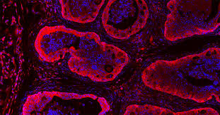 Prostate cancer symptoms might not be apparent in the early stages of the disease, and can be varied based on each person. New Study Reveals Weakness In Emerging Type Of Aggressive Prostate Tumor