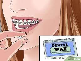 On the other hand, top braces can't hurt much as there is hard palate in the upper jaw. How To Deal With Brace Pain 10 Steps With Pictures Wikihow Health