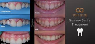 Some people with braces may be shy about smiling. How To Fix A Gummy Smile Causes And Treatment Oasis Dental Studio