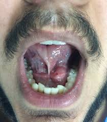 Image result for Sialolithiasis