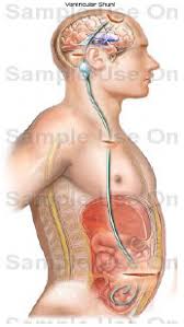 Ventriculoperitoneal Shunt Insertion Procedure Katy Richmond The Woodlands