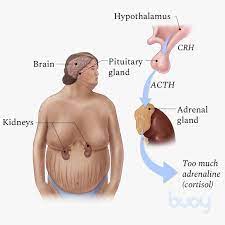 Cushing Syndrome What The Symptoms Are How To Treat Buoy