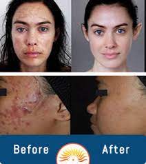 Maybe you would like to learn more about one of these? Chemical Peels Near Me Cary Nc Call 919 629 9261 Inshape Medical