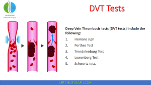 Image result for Perthes Test