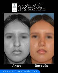 La pregunta más frecuente que me hacen: ¿Cuánto cuesta mi procedimiento  estético?🤔💉 La respuesta no es simple y depende de factores clave.  Encuéntralos hoy en www.doctoredwinvelez.com, donde te explico  detalladamente cómo determinamos