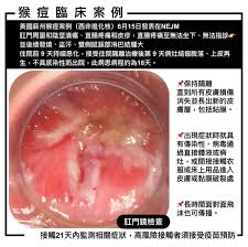 醫貼病例報告若得猴痘超痛…肛門、陰莖潰瘍排便、睡覺都有問題| 好房網News