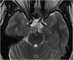 Looking for online definition of hamartoma in the medical dictionary? Tuber Cinereum Hamartoma An Axial T 2 Weighted Mr Image Of The Brain Download Scientific Diagram