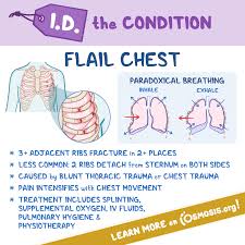 Image result for Flail Chest