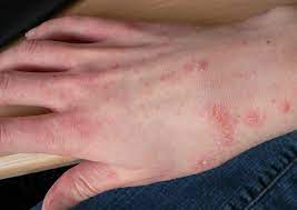 A sarna é uma infecção fortemente contagiosa. Que Es La Escabiosis O Sarna Les Laboratorio Especializado Del Sur