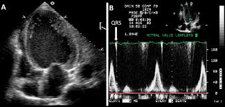 Journal of the american college of cardiology vol. Echocardiography Findings In Common Primary And Secondary Cardiomyopathies Intechopen