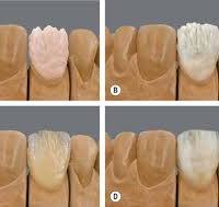 22: Dental ceramics | Pocket Dentistry