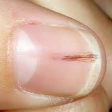 Tiny black lines or dots under nail can simply be as a result of an injury a nail infection or different underlying medical condition. What Do Nail Problems Mean For Your Health