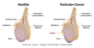 There will be collection of fluid in the scrotum. Testicular Cancer Treatment In India In Depth Explanation