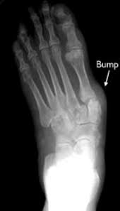 Rheumatoid Arthritis Of The Foot And Ankle Orthoinfo Aaos